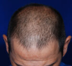 Hair Transplant