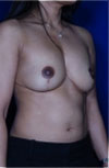 Revisional Breast Augmentation